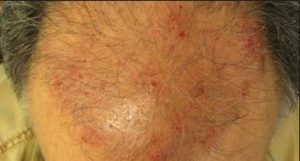 Hair Follicle Infection on Scalp