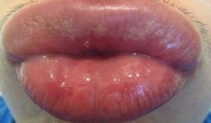 How to Get RId of Fordyce Spots on Lip