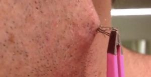 Infected Hair Follicle Pulled out