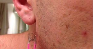 Ingrown Facial Hair