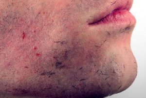 Ingrown Facial Hair Bump