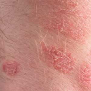 Itchy Red Patches on Skin could be Eczema or Psoriasis Pictures