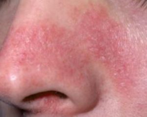 Red Dry Skin around Skin