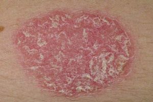 Red Patches on Skin, chronic Psoriasis