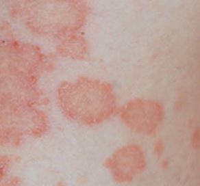 Red Patches on Skin