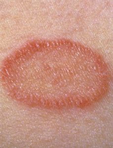 Red Ptaches on Skin, Pityriasis Rosea Picture