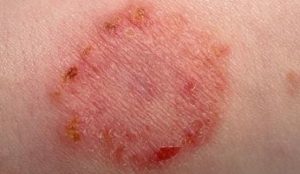 Ringworm is a common cause for ring like rash or Patch on skin