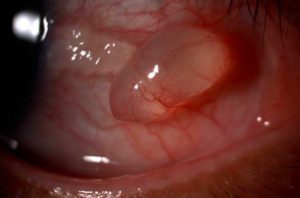 A Cyst on Eyeball Picture