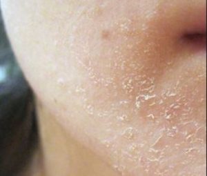Causes of Dry Flaky Skin on Face