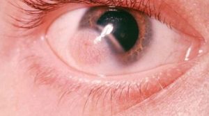 Dermoid Cyst on Eyeball