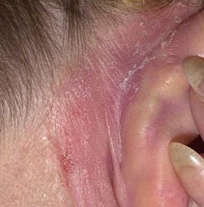 Dry Skin behind Ear