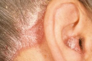 Dry Skin behind Ears could be Psoriasis