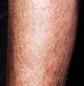 Dry Skin on Legs