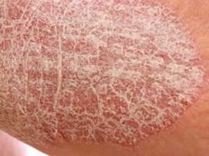 Dry Skin on Legs Picture