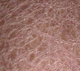 Extremely Dry Skin on Legs looks like Scales