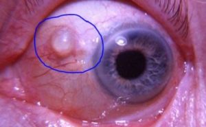 Fluid - Filled Cyst on Eyeball