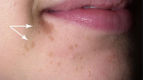 Flat Warts on Face Picture