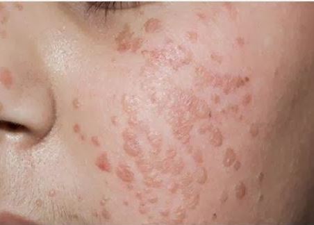 Warts on Face caused by direct contact with HPV