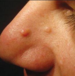 nose bump lump side skin tiny painful causes inside rid spots bumps under piercing tip bridge removal remove