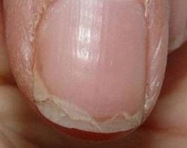 Peeling Nail Causes