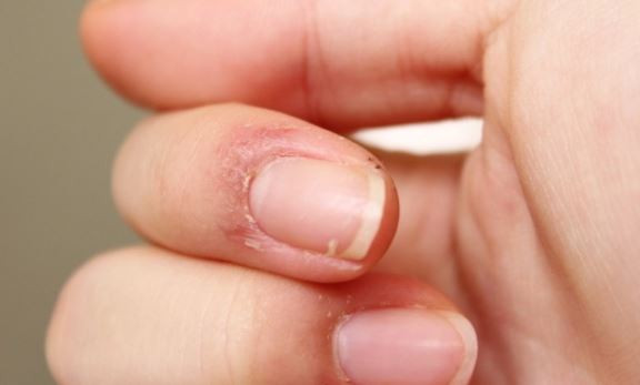 Skin Peeling around Nails