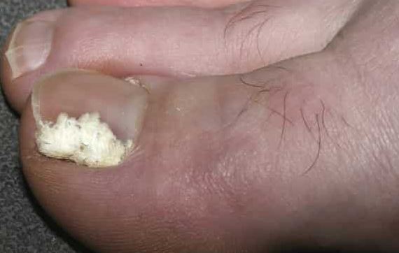 White Spots on Toenail due to Fungal infection Picture
