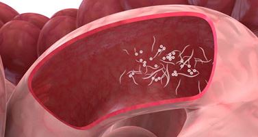 Pinworm rash anus picture