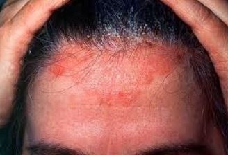 Picture, Image of Shingles on Scalp