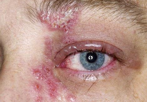 Shingle rash over the eye