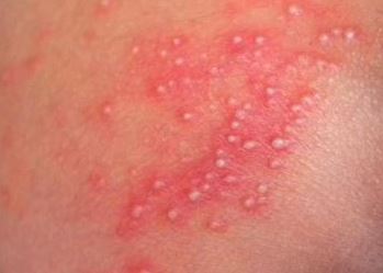Yeast Infection Bumps, Pimples Pictures