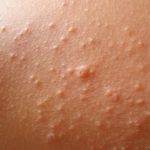 Bumpy Skin Rash not Itchy