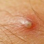 infected-ingrown-hair-on-scrotum