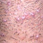 ingrown-hair-on-testicle-sac-picture