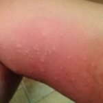 inner-thigh-rash-picture
