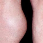 lump-behind-knee-bakers-cyst-image