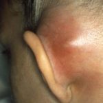 mastoiditis-infection-behind-the-ear-lobe