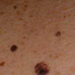 mole-on-arm-cancer-symptom