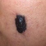 mole-on-skin-with-hair