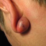 painful-cyst-lump-behind-the-ear