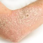 Picture of Skin Rashes on Arm