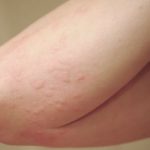 Rash on Arms Symptoms