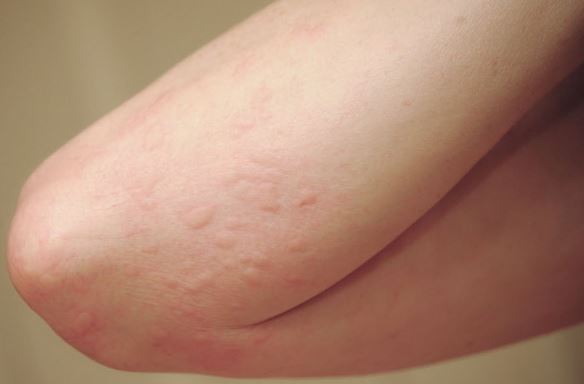 Rash On Arms And Legs Itchy Red Causes Small Bumps Pictures Not Itchy Skin Rash On Arms 