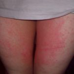 rash-on-inner-thigh-female-picture