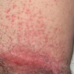 rash-on-inside-thigh-near-groin