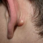 small-lump-behind-ear