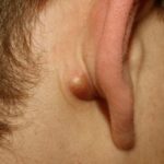 sore-pea-size-lump-behind-the-ear-lobe