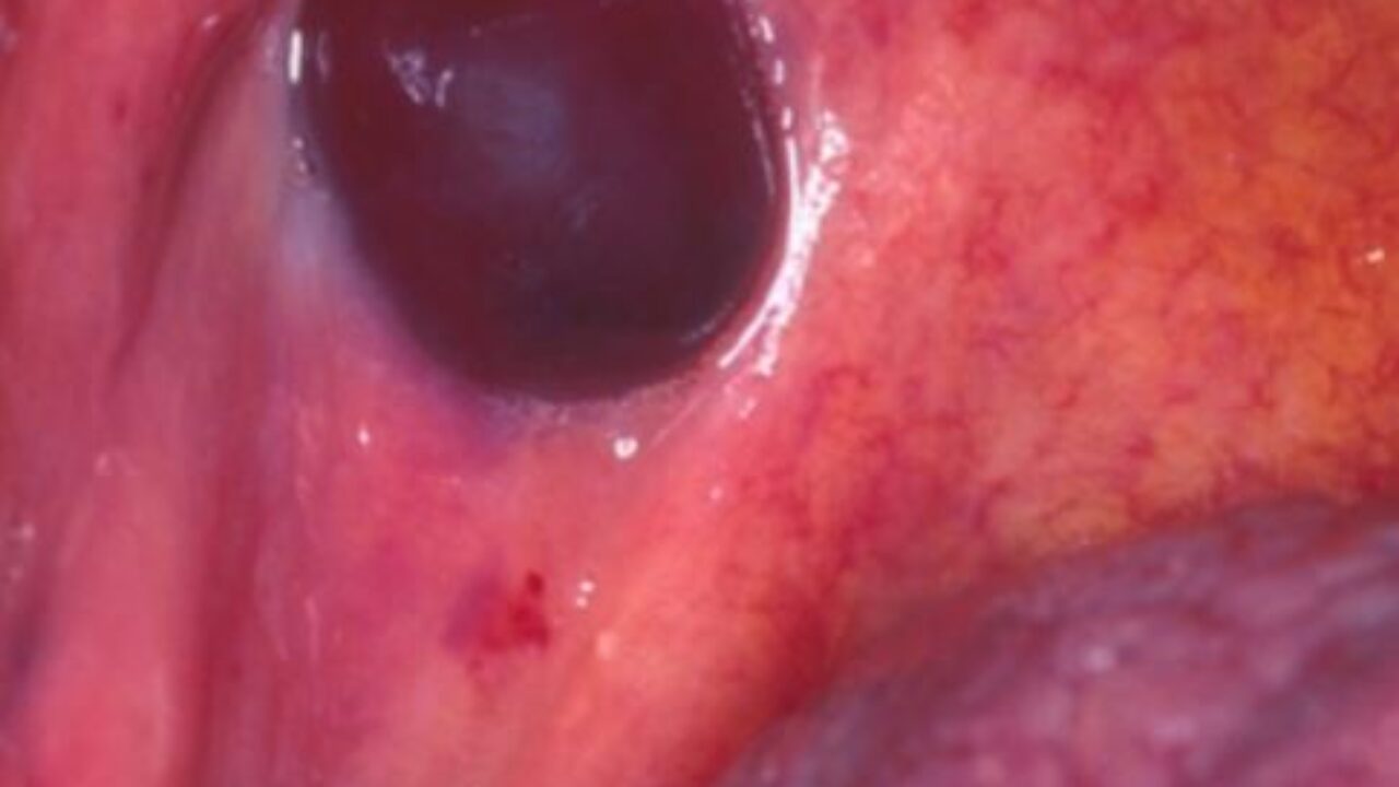 blood blister in mouth