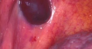 problem blister mouth in  Archives Blister MD  Treat Blood Mouth