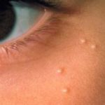 bumps-like-spots-on-face-near-eye