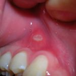 canker-sore-on-gum-above-tooth